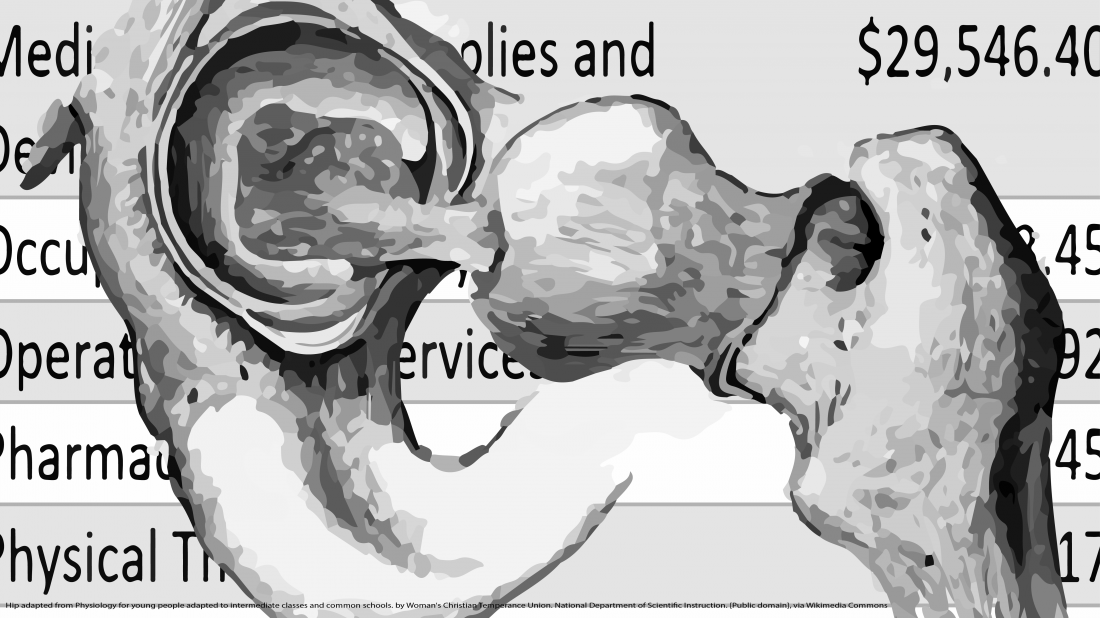 The value of a hip replacement surgery
